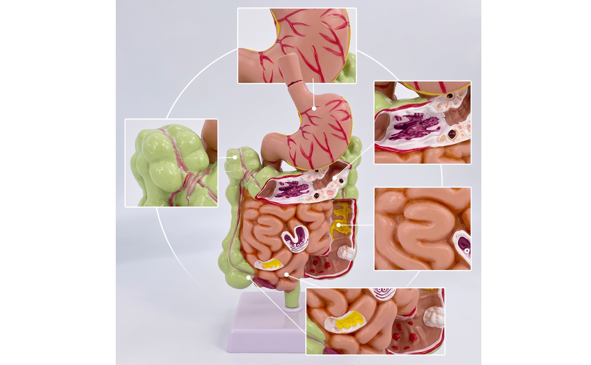 Large Intestine Model with Stomach Pathology for Classroom, Doctors, Teachers