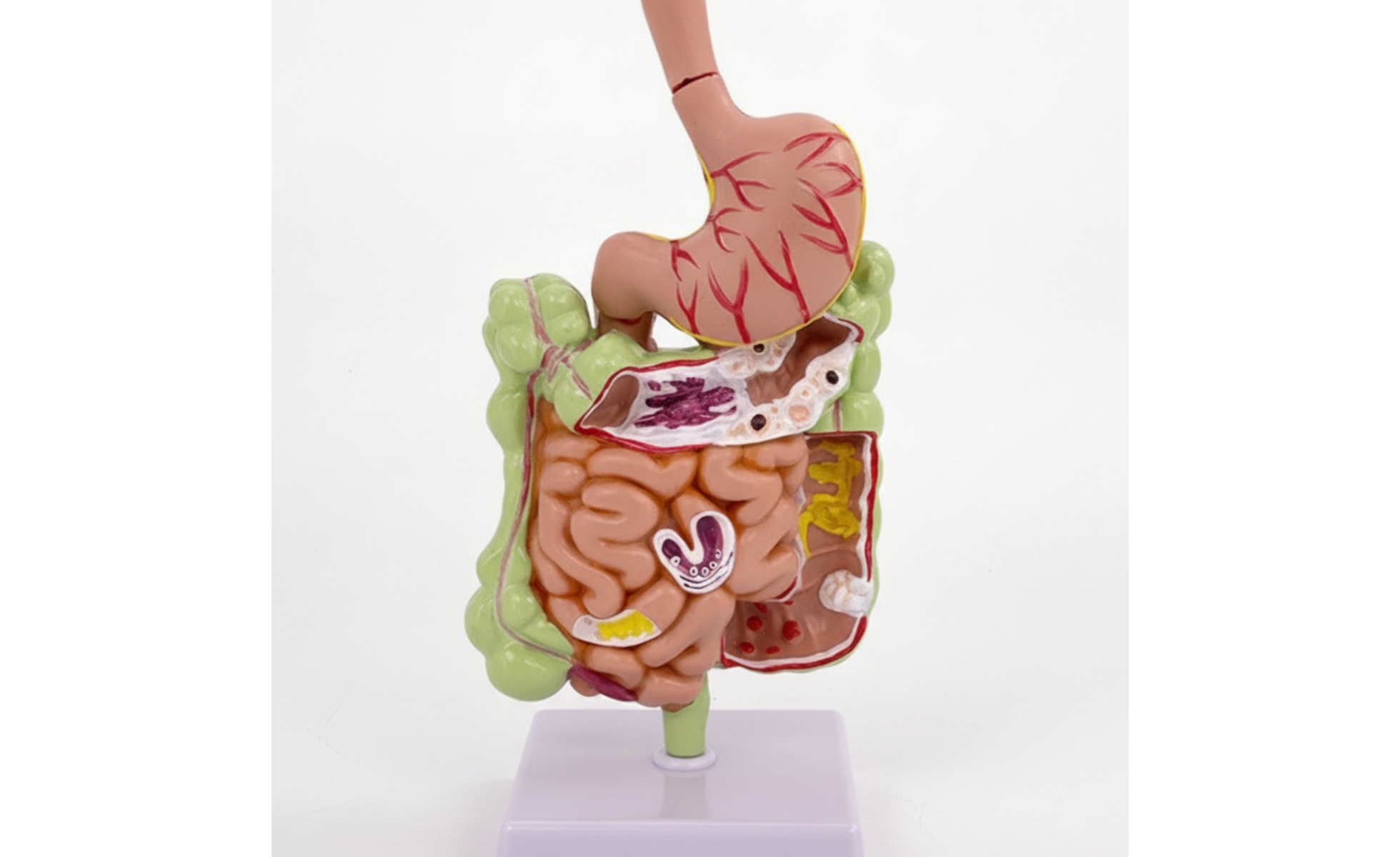Large Intestine Model with Stomach Pathology for Classroom, Doctors, Teachers