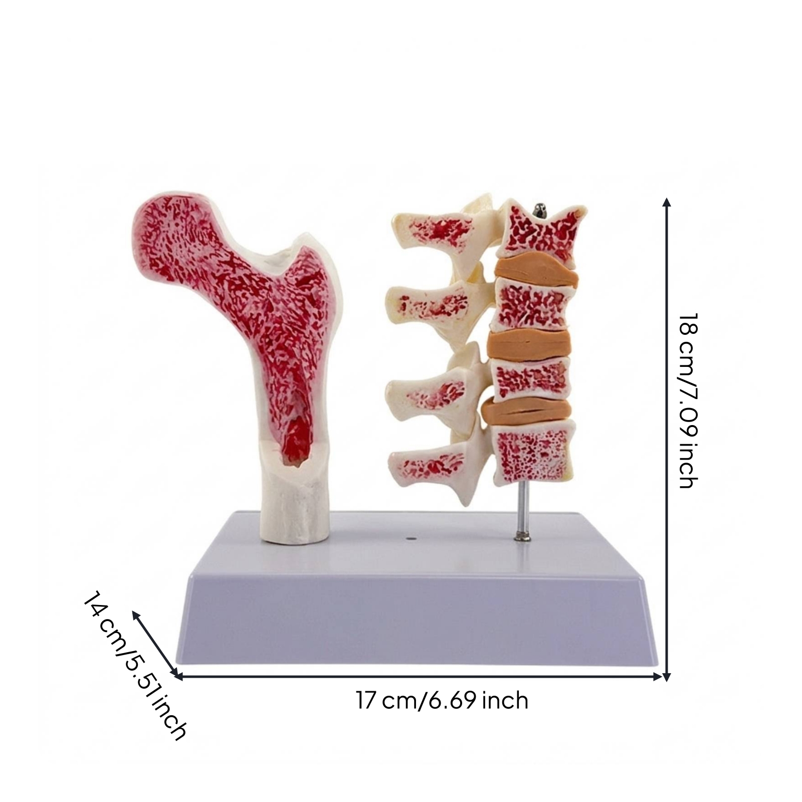 Spine and Femur Model Educational Osteoporosis Model Robust for Teachers